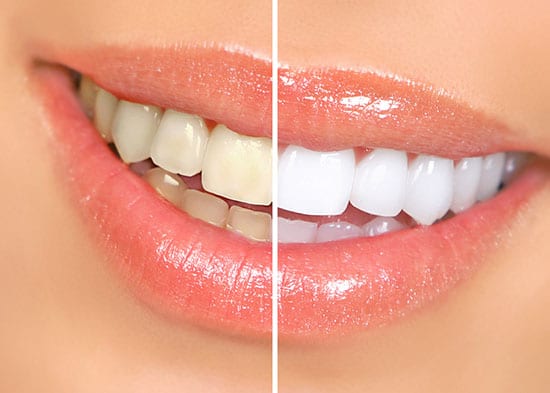 teeth-cleaning-pickering