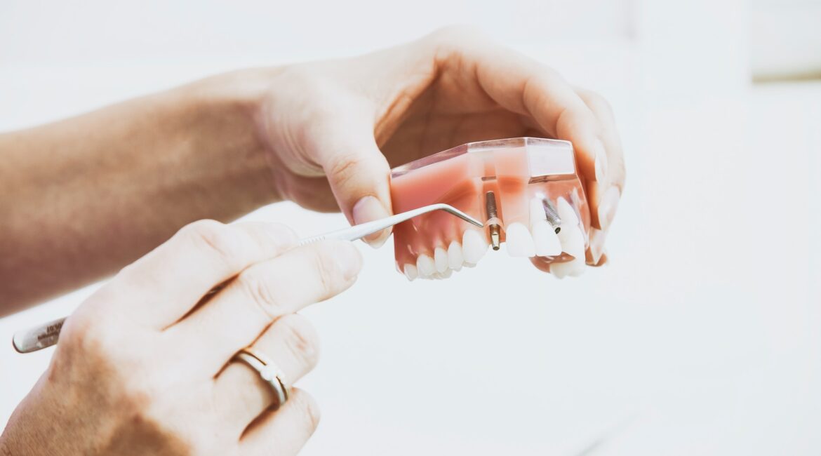 Dental Bridges