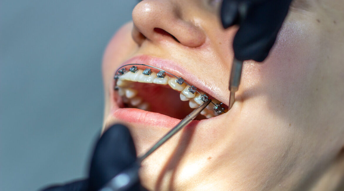 orthodontic treatment