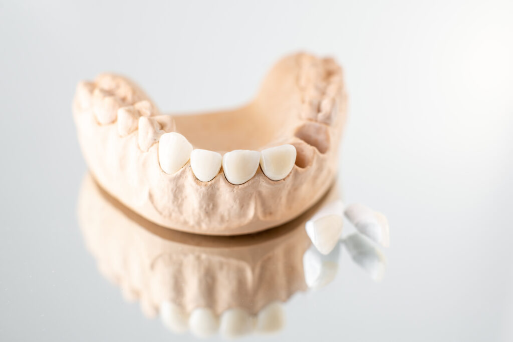 Dental Bridges