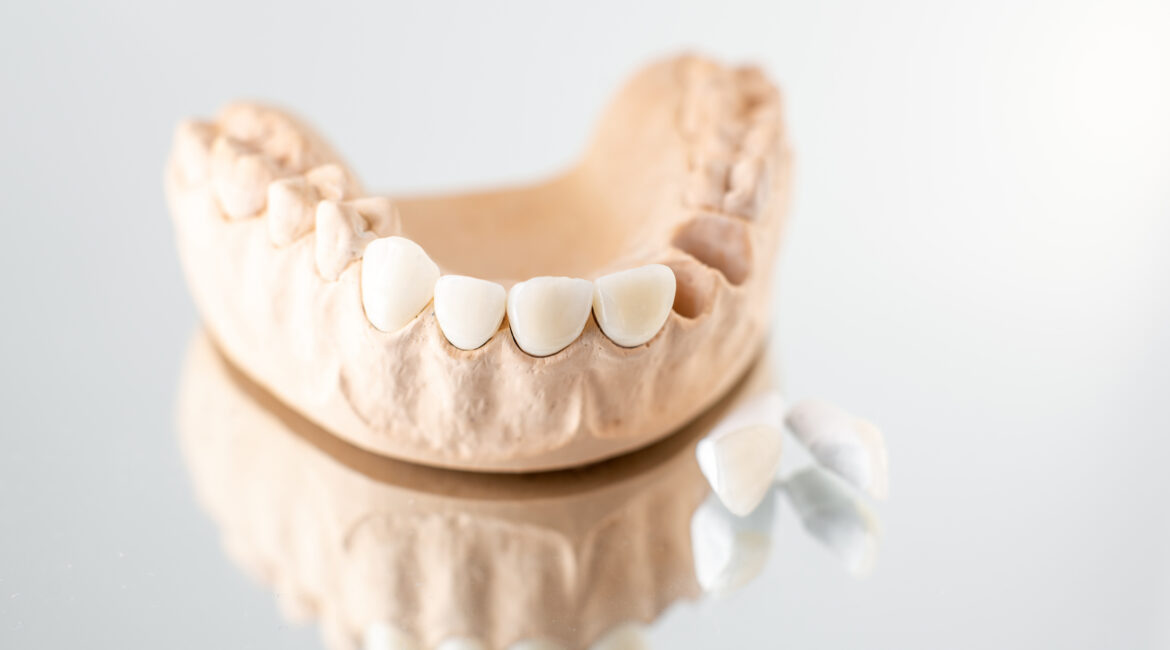 Dental Bridges