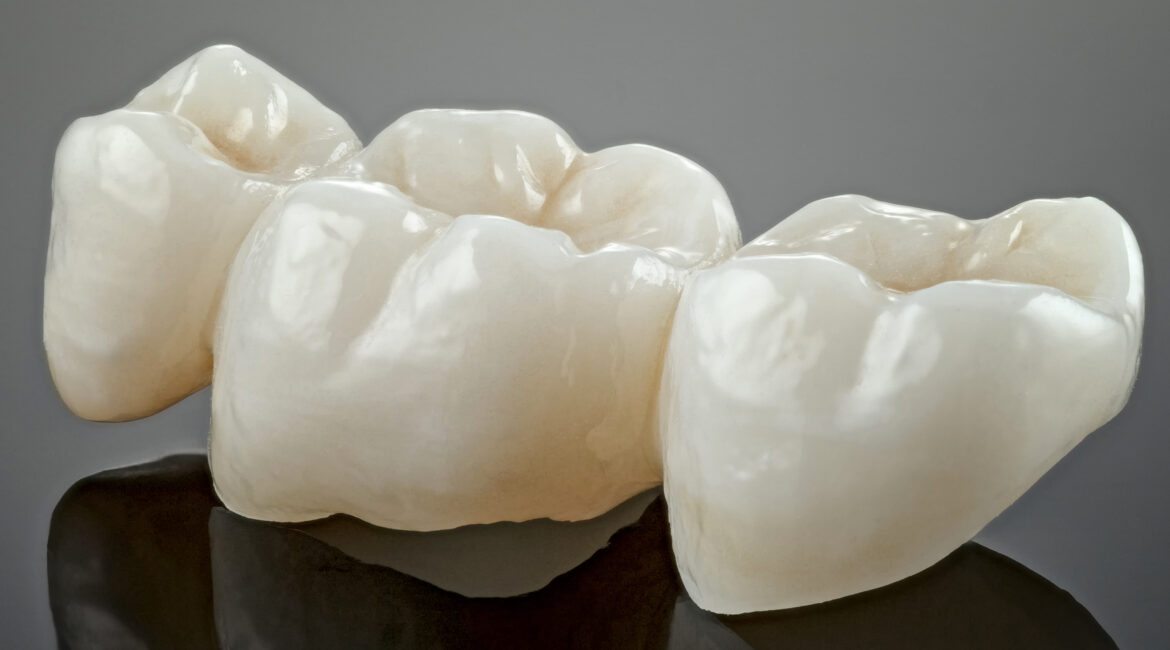 Dental-Crowns