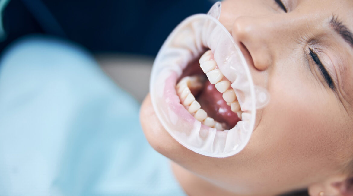 root canal