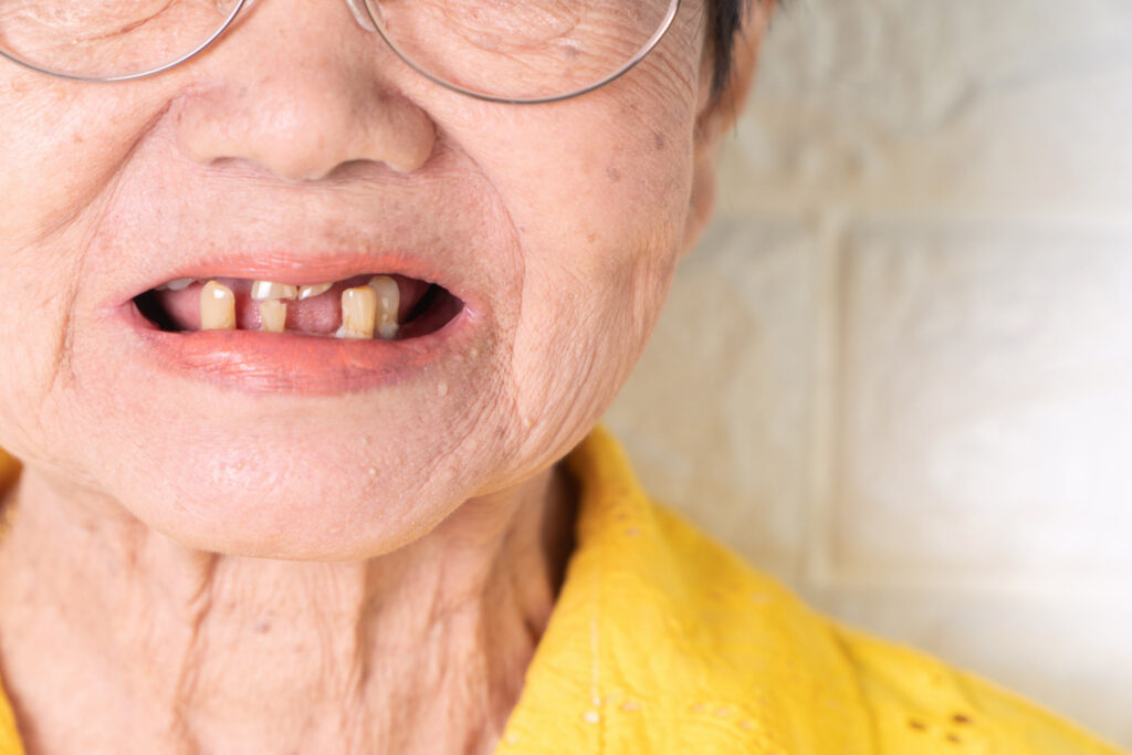 missing teeth