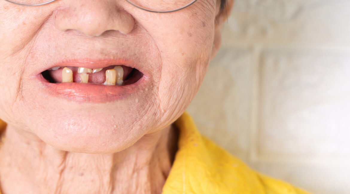 missing teeth