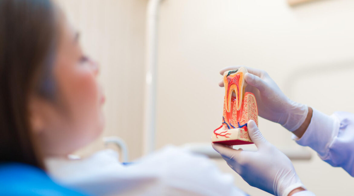 root canal