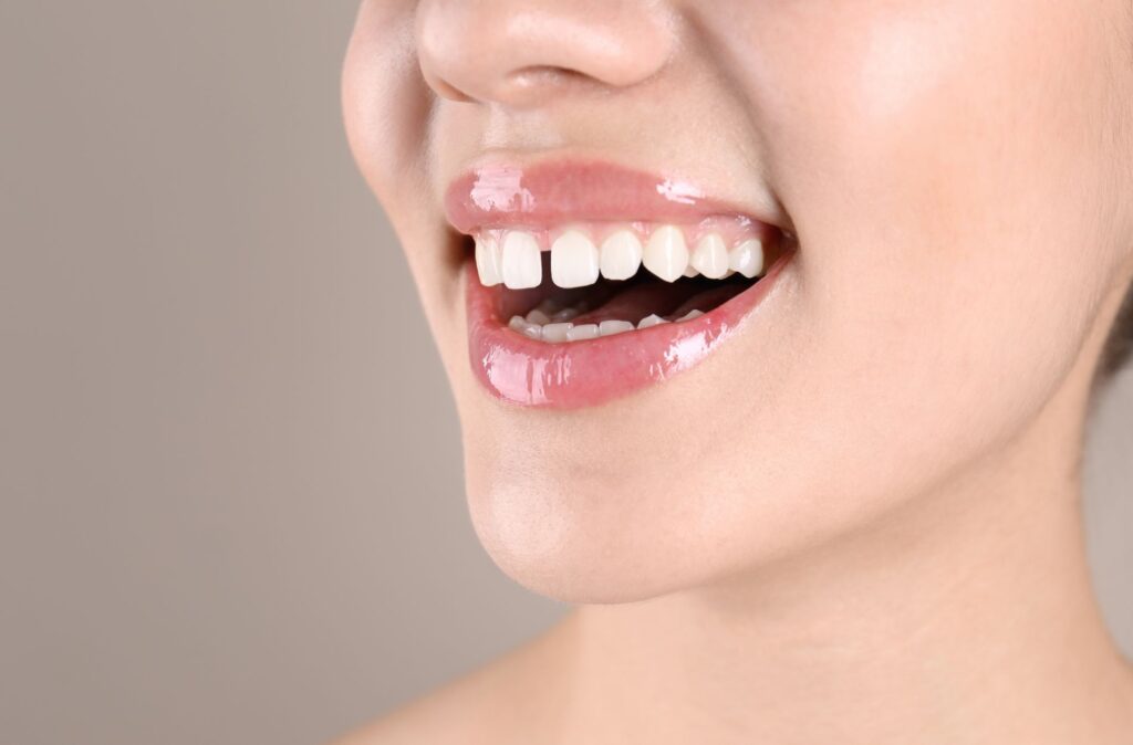 teeth gap