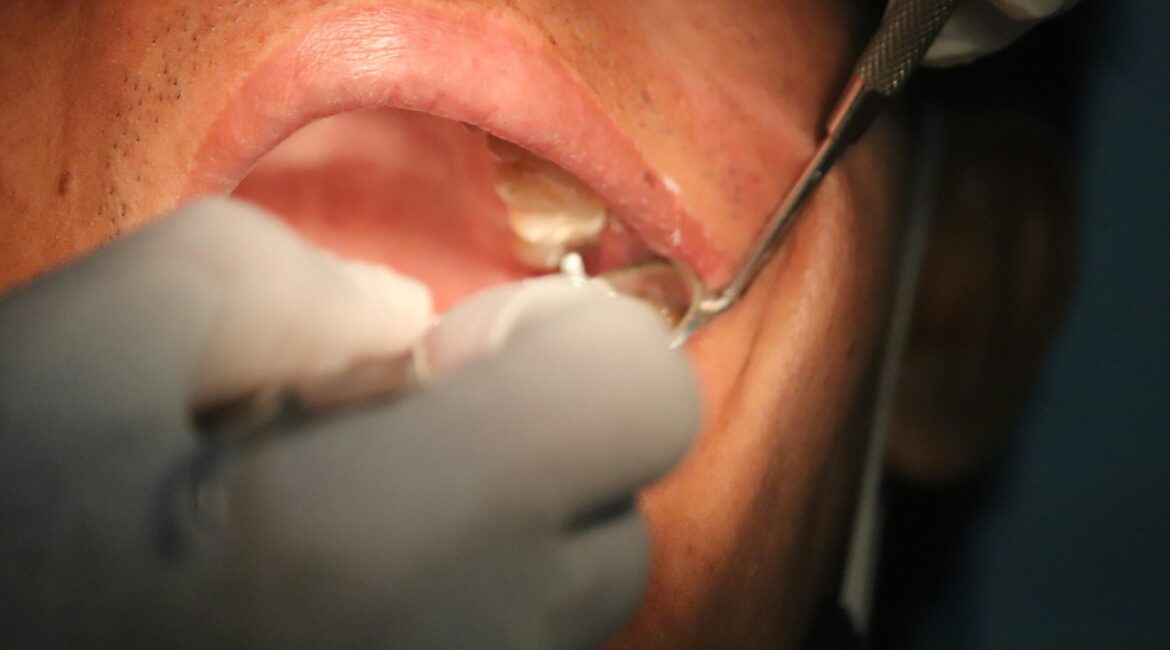 Wisdom Teeth Removal