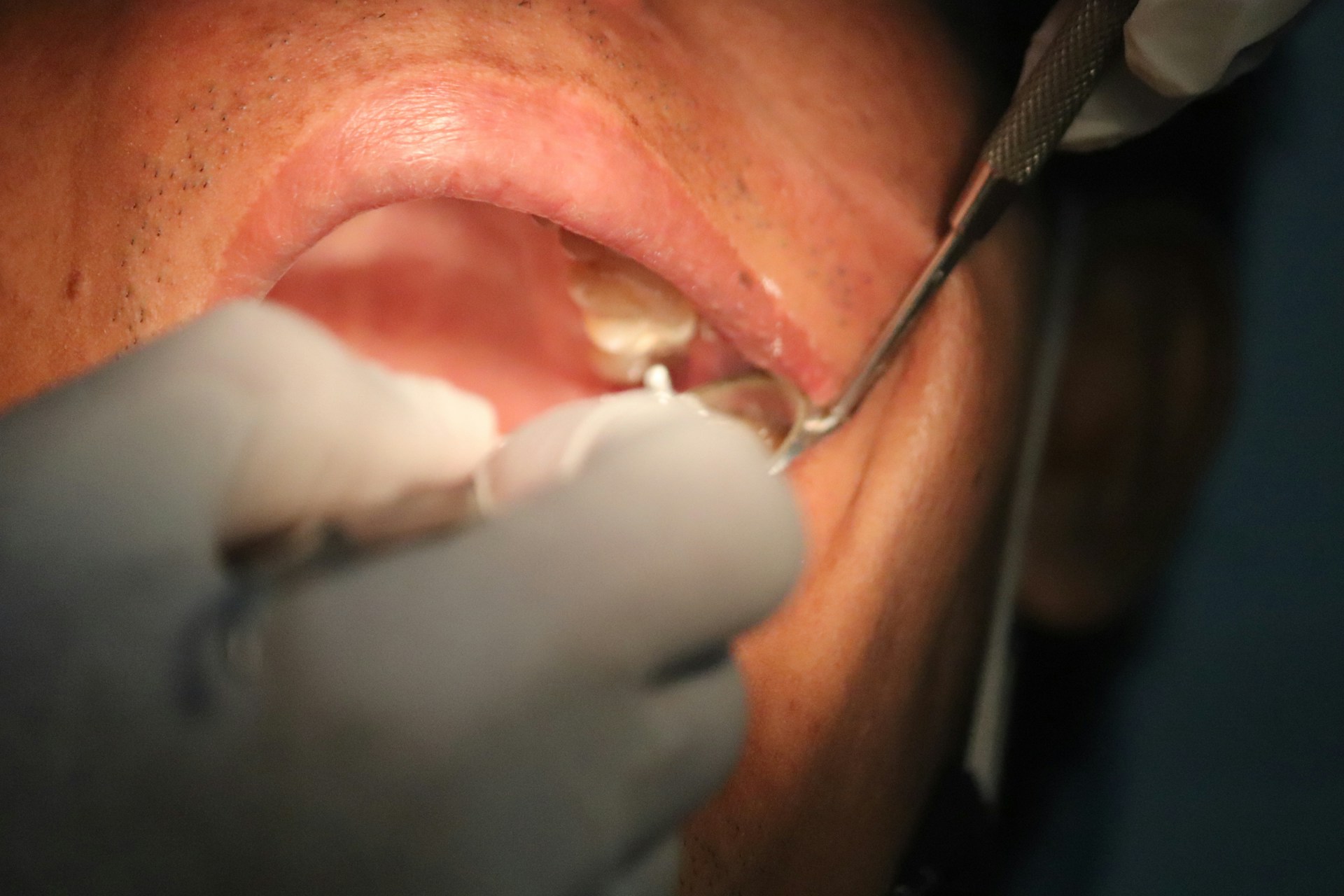 Wisdom Teeth Removal