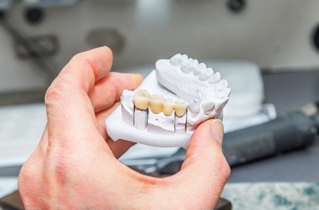 dental bridge